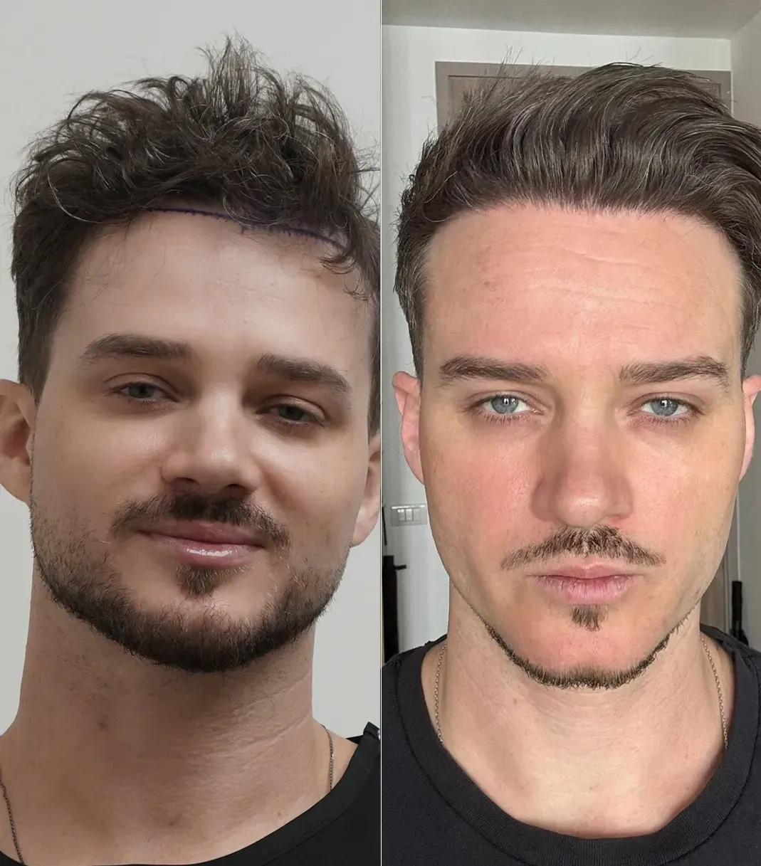 Alex P. before and after