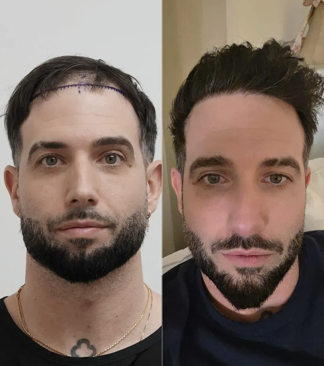 Ryan K. before and after
