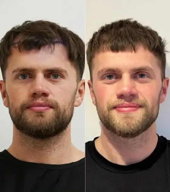 Prima e dopo