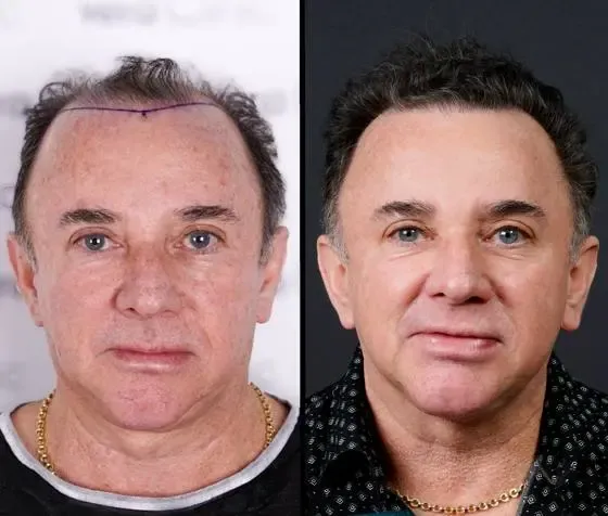 Prima e dopo